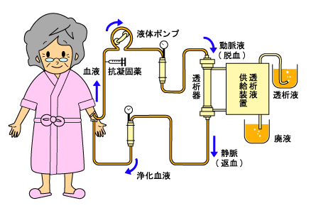 人工透析の流れ